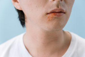 A close-up image of a person's lips showing a cold sore on the lower lip area. Un gros plan d'une personne montrant un bouton de fièvre sur la zone de la lèvre inférieure.